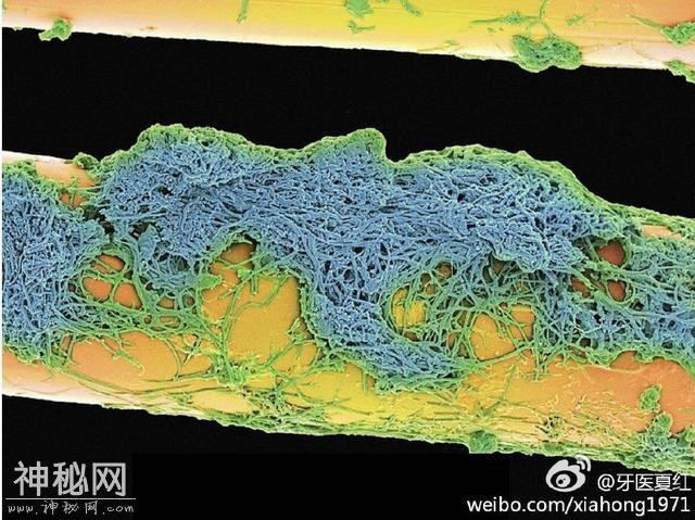 牙齿上的细菌-3.jpg