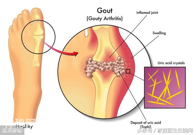 痛风急性发作时，身体会亮出这些“信号灯”，不是小事-2.jpg