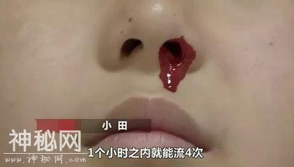 12岁男孩得怪病一学习就流鼻血，至今未找到病因，父母快急疯了-2.jpg