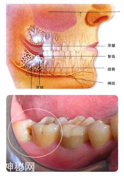 什么是智齿？为什么会长智齿？它有什么危害？一定要拔掉吗？-2.jpg