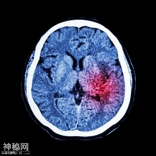 脑梗塞患者应该怎么进行饮食保健呢-1.jpg