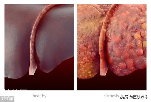 近期身体有3个表现，可能肝硬化正在“癌变”，快看医生-1.jpg