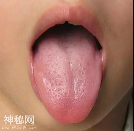 湖北25岁女孩舌头“突然发黑” 医生：肾太虚了，身体完全透支！-4.jpg