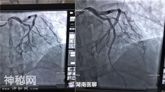 心梗“魔爪”已悄然伸向中青年！专家：这样养生保健可远离心梗-1.jpg