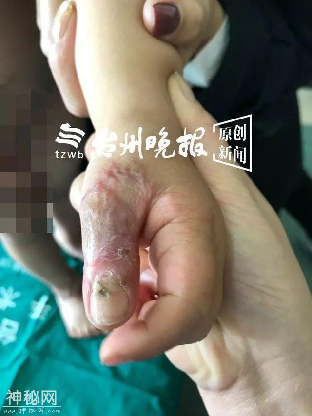 可怜！3岁娃得怪病身上长满“兽皮”，千里寻医到台州-5.jpg