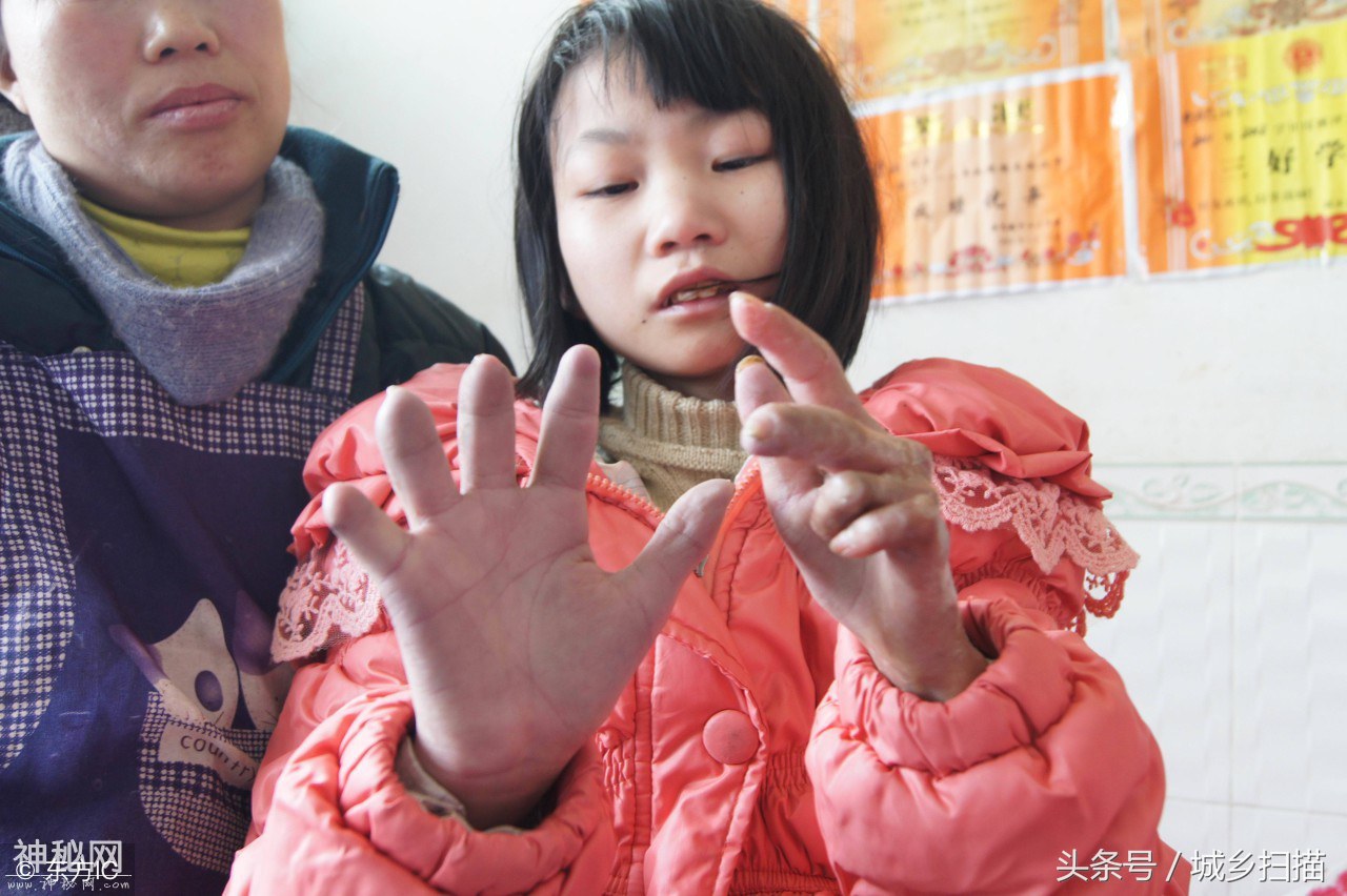 皮肤变黑变硬脱落，16岁女孩患“怪病”8年，可惜一直没查出病因-3.jpg