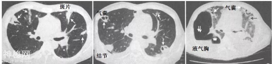 教你从肺CT上分辨是哪种细菌感染丨葡萄球菌肺炎篇-3.jpg