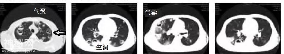 教你从肺CT上分辨是哪种细菌感染丨葡萄球菌肺炎篇-2.jpg