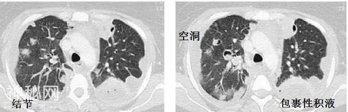 教你从肺CT上分辨是哪种细菌感染丨葡萄球菌肺炎篇-8.jpg