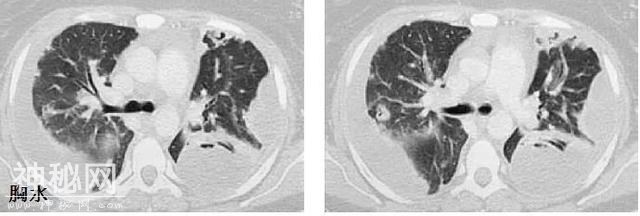 教你从肺CT上分辨是哪种细菌感染丨葡萄球菌肺炎篇-9.jpg