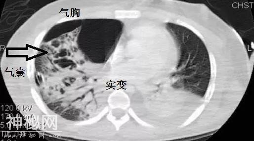 教你从肺CT上分辨是哪种细菌感染丨葡萄球菌肺炎篇-11.jpg