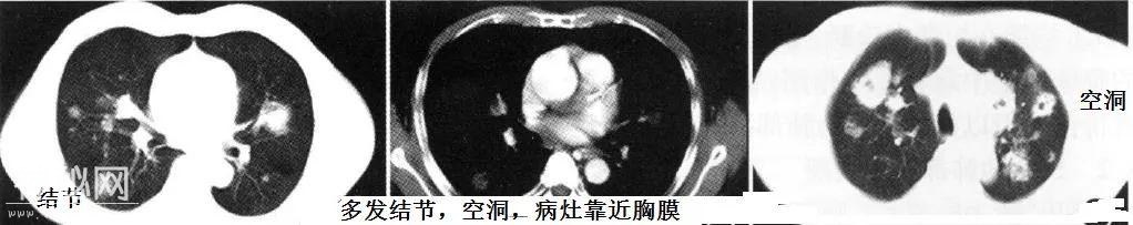 教你从肺CT上分辨是哪种细菌感染丨葡萄球菌肺炎篇-4.jpg