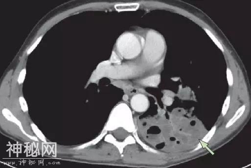 教你从肺CT上分辨是哪种细菌感染丨葡萄球菌肺炎篇-5.jpg