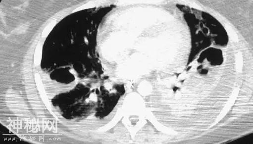 教你从肺CT上分辨是哪种细菌感染丨葡萄球菌肺炎篇-10.jpg