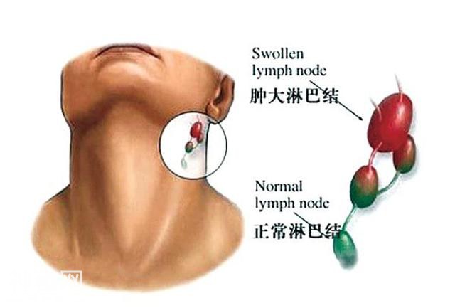 癌症都是静悄悄的，但是出现以下四个标志，提示身体内有癌症-2.jpg