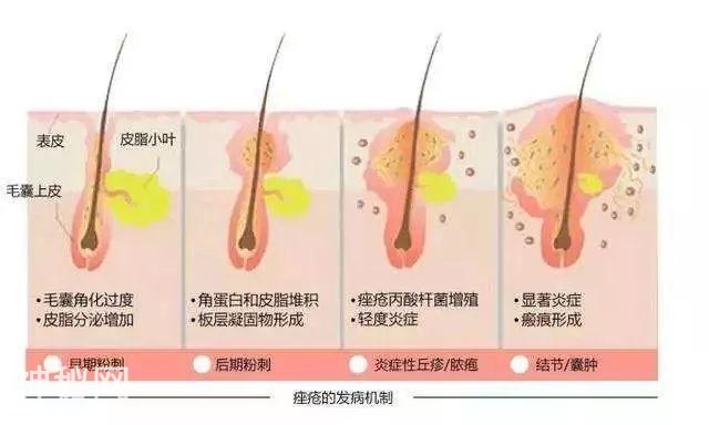 为啥痘痘总找你？皮肤科医生教你专业“战痘法”-4.jpg