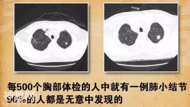 咳嗽、吐白痰、胸闷、憋气身体虚，小心是肺结节-1.jpg