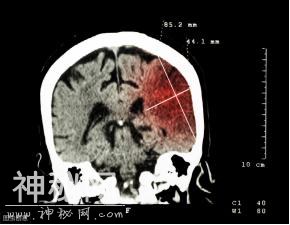 脑梗“加速器”找到了，医生：身体出现“1软、2硬”，快检查-1.jpg