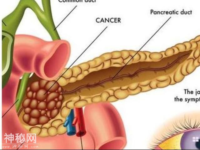 胰腺癌-癌症之王，从确诊到死亡只有一年，发病后有四个蛛丝马迹-2.jpg