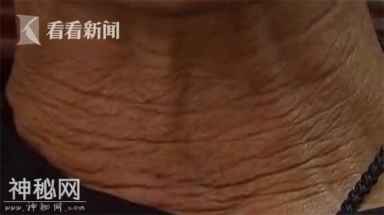 3年未进一粒米！中年男子得"怪病"一吃就吐，暴瘦40多斤-2.jpg