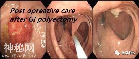 胃肠息肉切除术后应知道的保健细节-1.jpg