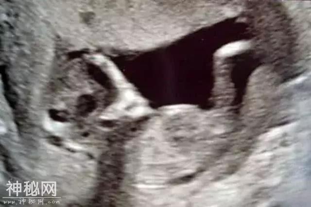 少女孕检时看到胎儿身后有“外星人”，担心被前男友诅咒-1.jpg