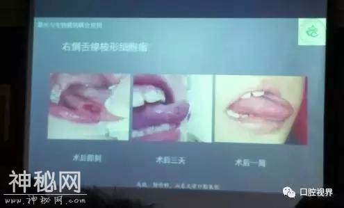 激光在口腔应用中的“灵异事件”《激光在口腔医学的应用学习班》-5.jpg