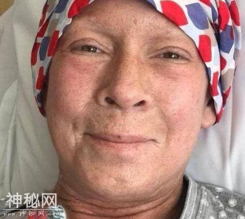 58岁女子患罕见怪病，皮肤像石头一样硬，最多只能活5年-5.jpg