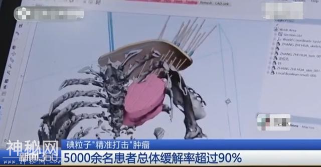 缓解率超90%！中国专家实施抗癌“新疗法”，治疗后癌细胞消失-3.jpg
